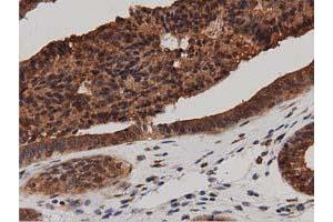 Immunohistochemical staining of paraffin-embedded Adenocarcinoma of Human ovary tissue using anti-DNAJA2 mouse monoclonal antibody. (DNAJA2 Antikörper)
