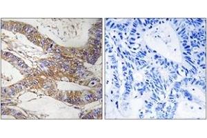 Immunohistochemistry analysis of paraffin-embedded human colon carcinoma tissue, using SERPINB9 Antibody. (SERPINB9 Antikörper  (AA 241-290))