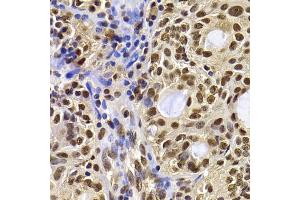 Immunohistochemistry of paraffin-embedded human oophoroma using HIRIP3 antibody (ABIN5974221) at dilution of 1/100 (40x lens). (HIRIP3 Antikörper)