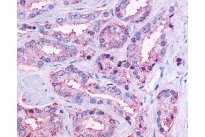 Anti-OR51E1 antibody IHC of human Prostate, Carcinoma. (OR51E1 Antikörper  (C-Term))