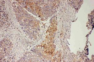 Anti-GRB7 antibody, IHC(P): Human Oesophagus Squama Cancer Tissue (GRB7 Antikörper  (Middle Region))