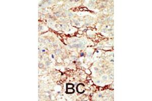 Formalin-fixed and paraffin-embedded human cancer tissue reacted with FGFR3 polyclonal antibody  , which was peroxidase-conjugated to the secondary antibody, followed by DAB staining. (FGFR3 Antikörper  (C-Term))