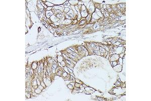 Immunohistochemistry of paraffin-embedded Human pancreatic ductal carcinoma using β-Catenin antibody (ABIN7266137) at dilution of 1:100 (40x lens). (CTNNB1 Antikörper)