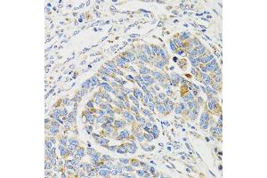 Immunohistochemistry of paraffin-embedded human esophageal cancer using SH2B1 Antibody (ABIN5973245) at dilution of 1/100 (40x lens). (SH2B1 Antikörper)