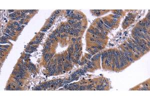Immunohistochemistry of paraffin-embedded Human colon cancer tissue using NFATC3 Polyclonal Antibody at dilution 1:50 (NFATC3 Antikörper)
