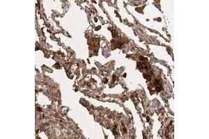 Immunohistochemical staining of human lung with ARL13A polyclonal antibody  shows strong cytoplasmic positivity in macrophages at 1:20-1:50 dilution. (ARL13A Antikörper)