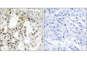 Immunohistochemistry analysis of paraffin-embedded human breast carcinoma tissue using EIF3D antibody. (EIF3D Antikörper  (Internal Region))