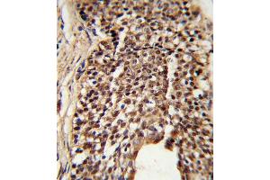 Formalin-fixed and paraffin-embedded human prostate carcinoma reacted with TPI1 Antibody (N-term), which was peroxidase-conjugated to the secondary antibody, followed by DAB staining. (TPI1 Antikörper  (N-Term))