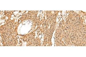 Immunohistochemistry of paraffin-embedded Human esophagus cancer tissue using TIPRL Polyclonal Antibody at dilution of 1:60(x200)