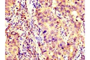 IHC image of ABIN7175618 diluted at 1:200 and staining in paraffin-embedded human pancreatic cancer performed on a Leica BondTM system. (KCNAB1 Antikörper  (AA 287-401))
