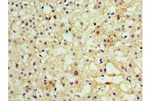 Immunohistochemistry of paraffin-embedded human liver cancer using ABIN7160457 at dilution of 1:100