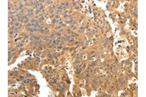 The image on the left is immunohistochemistry of paraffin-embedded Human ovarian cancer tissue using ABIN7130780(PTPRE Antibody) at dilution 1/10, on the right is treated with fusion protein. (PTPRE Antikörper)