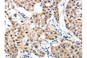 The image on the left is immunohistochemistry of paraffin-embedded Human lung cancer tissue using ABIN7191763(P2RY6 Antibody) at dilution 1/40, on the right is treated with synthetic peptide. (P2RY6 Antikörper)