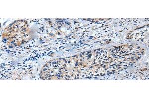 Immunohistochemistry of paraffin-embedded Human cervical cancer tissue using LILRB5 Polyclonal Antibody at dilution of 1:25(x200) (LILRB5 Antikörper)