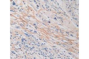 IHC-P analysis of Human Stomach Cancer Tissue, with DAB staining. (Periostin Antikörper  (AA 97-230))