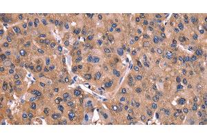 Immunohistochemistry of paraffin-embedded Human liver cancer tissue using ADM2 Polyclonal Antibody at dilution 1:40 (Adrenomedullin 2 Antikörper)