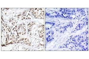 Immunohistochemical analysis of paraffin-embedded human breast carcinoma tissue using SAPK/JNK (phospho-Thr183) antibody (E011249). (SAPK, JNK (pThr183) Antikörper)