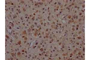 IHC image of ABIN7127867 diluted at 1:100 and staining in paraffin-embedded human glioma cancer performed on a Leica BondTM system. (Rekombinanter VCP Antikörper)