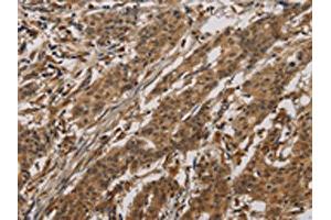 The image on the left is immunohistochemistry of paraffin-embedded Human gastric cancer tissue using ABIN7190293(CLEC2A Antibody) at dilution 1/20, on the right is treated with synthetic peptide. (CLEC2A Antikörper)