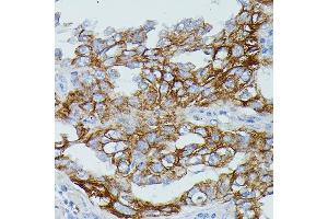 Immunohistochemistry of paraffin-embedded human lung cancer using FCGR1B antibody (ABIN7267161) at dilution of 1:100 (40x lens). (FCGR1B Antikörper)