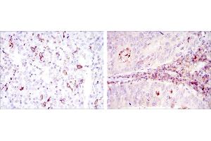 Immunohistochemical analysis of paraffin-embedded cervical cancer tissues (left) and colon cancer tissues (right) using CD1A mouse mAb with DAB staining. (CD1a Antikörper)