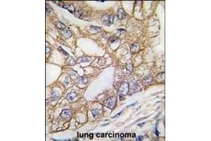 Formalin-fixed and paraffin-embedded human lung carcinoma tissue reacted with Ihh Antibody (N-term) (ABIN389152 and ABIN2850533) , which was peroxidase-conjugated to the secondary antibody, followed by DAB staining. (Indian Hedgehog Antikörper  (N-Term))