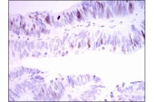 Immunohistochemical analysis of paraffin-embedded rectum cancer tissues using INCENP mouse mAb with DAB staining. (INCENP Antikörper  (AA 369-583))