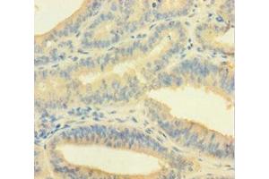 Immunohistochemistry of paraffin-embedded human endometrial cancer using ABIN7148691 at dilution of 1:100 (Crossover junction endonuclease EME1 (EME1) (AA 1-583) Antikörper)