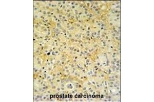 DAZ Antibody (C-term) (ABIN653931 and ABIN2843163) IHC analysis in formalin fixed and paraffin embedded prostate carcinoma followed by peroxidase conjugation of the secondary antibody and DAB staining.