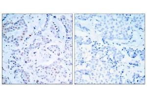 Immunohistochemical analysis of paraffin-embedded human breast carcinoma tissue using Estrogen Receptor-α (Ab-104) antibody (E021065). (Estrogen Receptor alpha Antikörper)