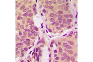 Immunohistochemical analysis of PI3K p85 alpha staining in human prostate cancer formalin fixed paraffin embedded tissue section.