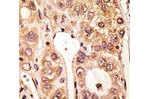 IHC analysis of FFPE human hepatocarcinoma tissue stained with the TLR5 antibody (TLR5 Antikörper  (AA 825-856))
