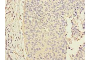 Immunohistochemistry of paraffin-embedded human cervical cancer using ABIN7146495 at dilution of 1:100 (CALML3 Antikörper  (AA 1-149))