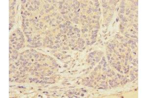 Immunohistochemistry of paraffin-embedded human ovarian cancer using ABIN7173562 at dilution of 1:100 (Tropomyosin 4 Antikörper  (AA 1-248))