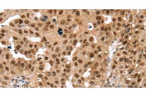 Immunohistochemistry of paraffin-embedded Human breast cancer using SMARCB1 Polyclonal Antibody at dilution of 1:30 (SMARCB1 Antikörper)