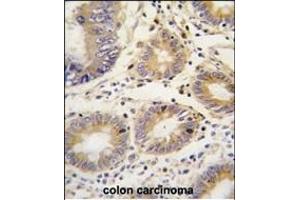 Formalin-fixed and paraffin-embedded human colon carcinoma tissue reacted with LEFTB antibody (C-term)  , which was peroxidase-conjugated to the secondary antibody, followed by DAB staining.