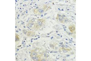 Immunohistochemistry of paraffin-embedded human liver cancer using SURF4 antibody (ABIN7270650) at dilution of 1:200 (40x lens). (Surfeit 4 Antikörper  (AA 50-150))