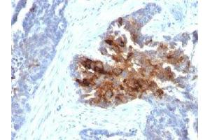 IHC staining of human ovarian carcinoma with TAG-72 antibody cocktail (B72. (TAG-72 Antikörper)
