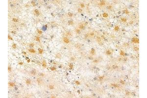 ABIN6264705 and ABIN6266630 at 1/100 staining human astrocytoma by IHC-P.