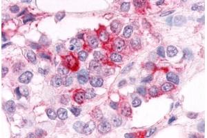 Anti-ESRRA antibody  ABIN1048581 IHC staining of human breast carcinoma. (ESRRA Antikörper  (Ligand Binding Domain))