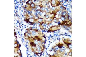 Immunohistochemistry of paraffin-embedded Human breast cancer using  Rabbit pAb (ABIN7265743) at dilution of 1:100 (40x lens). (ABCF3 Antikörper  (AA 1-200))