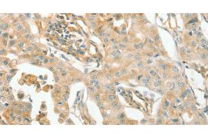 Immunohistochemistry of paraffin-embedded Human lung cancer using ACE1 Polyclonal Antibody at dilution of 1:70 (Angiotensin I Converting Enzyme 1 Antikörper)