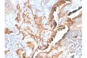 Formalin-fixed, paraffin-embedded human Lung Carcinoma stained with Tenascin C Rabbit Recombinant Monoclonal Antibody (TNC/2981R). (Rekombinanter TNC Antikörper)