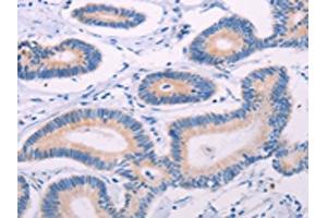 The image on the left is immunohistochemistry of paraffin-embedded Human colon cancer tissue using ABIN7131322(TEKT4 Antibody) at dilution 1/20, on the right is treated with fusion protein. (Tektin 4 Antikörper)
