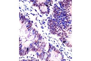(ABIN6242416 and ABIN6578503) staining KHDRBS1 in human colorectal carcinoma tissue sections by Immunohistochemistry (IHC-P - paraformaldehyde-fixed, paraffin-embedded sections). (KHDRBS1 Antikörper  (AA 259-291))