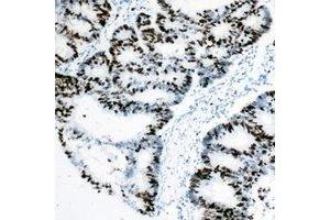 Immunohistochemical analysis of Rpb1 CTD staining in human colon cancer formalin fixed paraffin embedded tissue section. (Rpb1 CTD Antikörper  (C-Term))