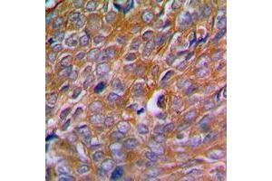 Immunohistochemical analysis of Calnexin (pS583) staining in human breast cancer formalin fixed paraffin embedded tissue section. (Calnexin Antikörper  (C-Term, pSer583))