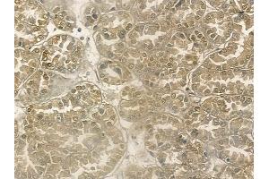 ABIN6266124 and ABIN6272493 at 1/100 staining human renal cell carcinoma by IHC-P.