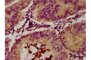 IHC image of ABIN7151818 diluted at 1:300 and staining in paraffin-embedded human endometrial cancer performed on a Leica BondTM system. (EPX Antikörper  (AA 140-300))