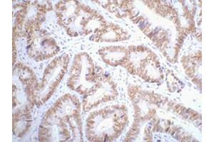 IHC-P staining of Human colon cancer tissue paraffin-embedded, diluted at 1:200. (p53 Antikörper)